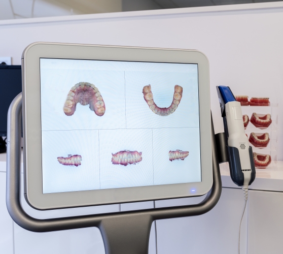 Digital models of teeth on computer screen