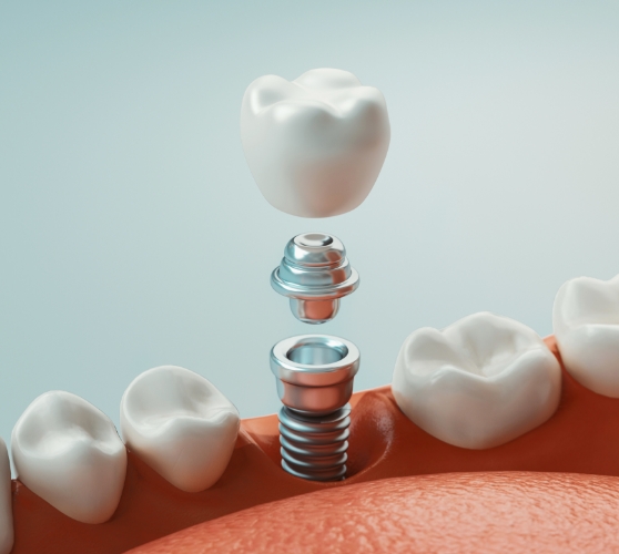 Illustrated dental implant with crown being placed in the lower jaw