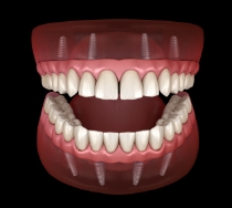 Illustrated implant dentures replacing both arches of teeth