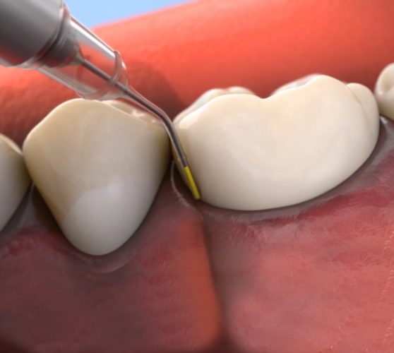 Illustrated dental instrument applying topical antibiotic to gums