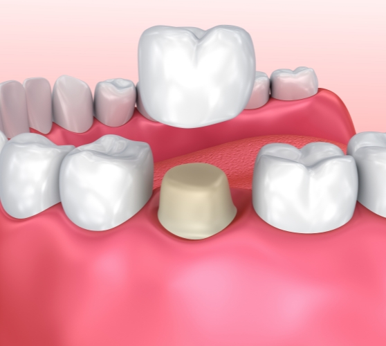 Illustrated dental crown being placed over a tooth